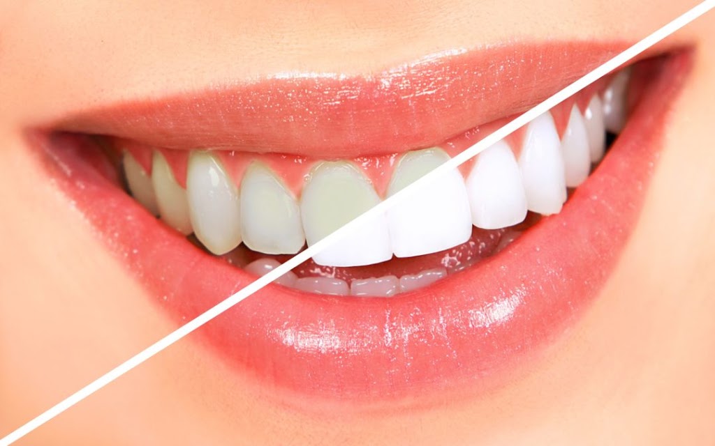 Whiter Smiles RVA | 7282 B Hanover Green Dr, Mechanicsville, VA 23111, USA | Phone: (804) 549-8098